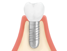 インプラントとは