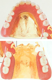 ゴールド床義歯