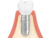 インプラント