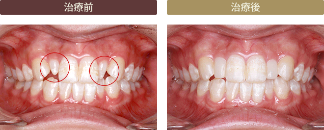 ダイレクトボンディング症例1　前歯